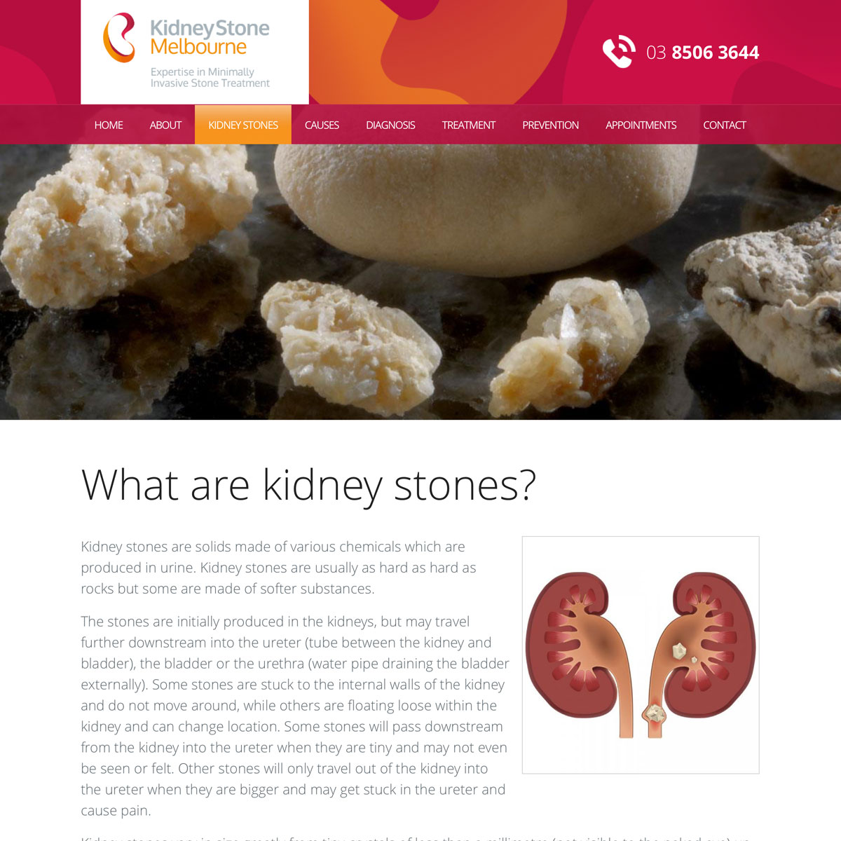 Kidney Stone Melbourne - Kidney Stones